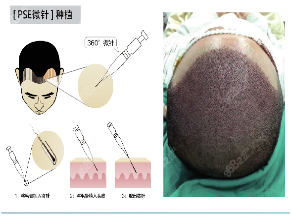 <!--<i data=20240705-sp></i>-->微针植发技术