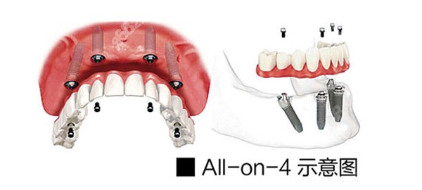 ALL-ON-4种植牙