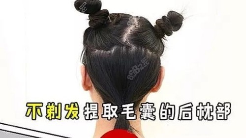 不剃发植发的优势