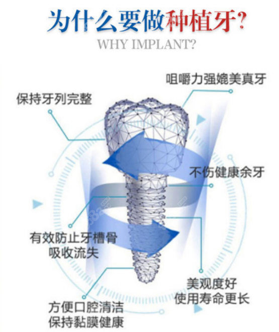 杭州雅莱口腔种植牙的优势