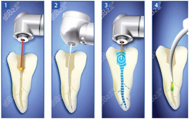 做根管治疗的步骤