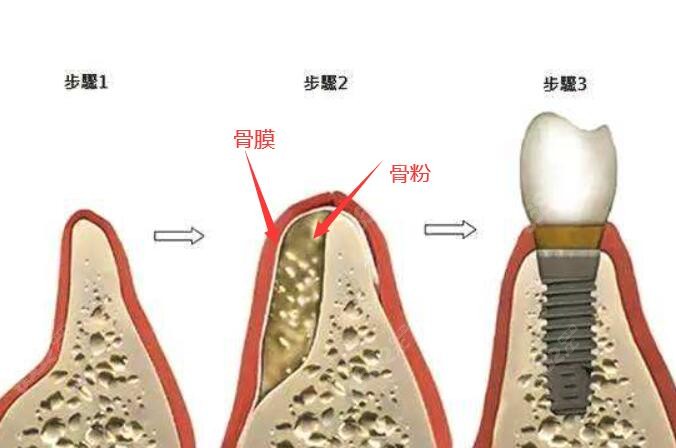 骨粉骨膜种植牙