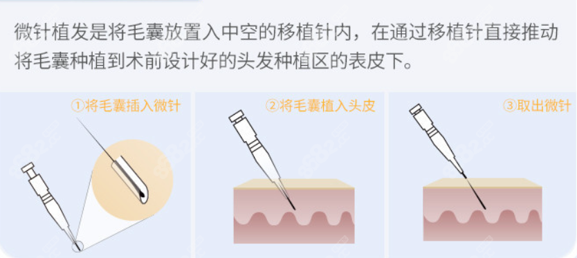 汕头华美的微针美学种植技术植发过程