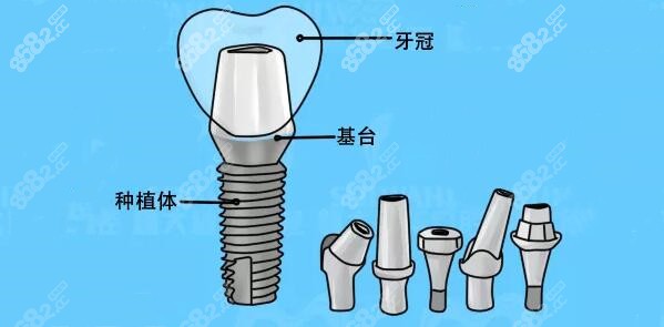 不同基台也决定了植牙收费