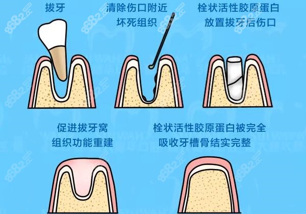 价格种植手术的复杂程度也有关