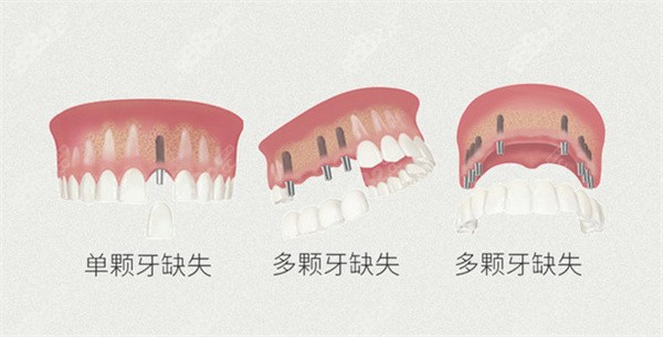 广州越秀区种植牙多少钱一颗