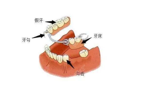 农村镶牙的过程图解图片