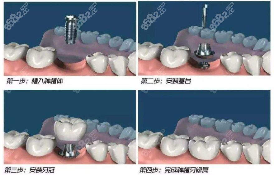 萍乡种植牙步骤