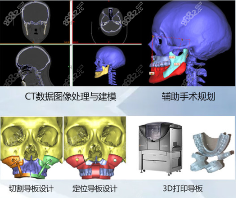 广州广大医院3d导板正颌技术