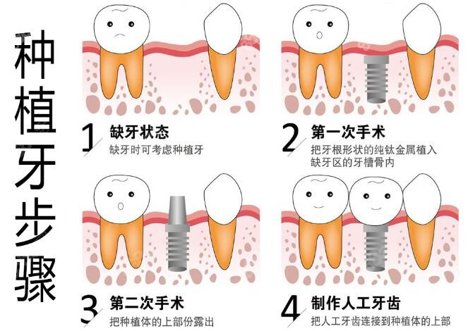 种植牙的步骤