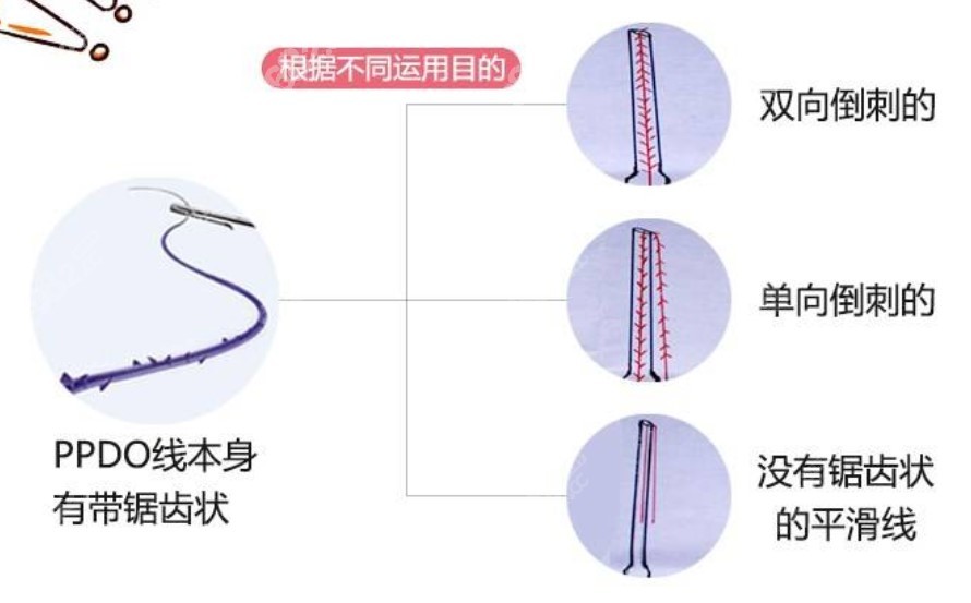 埋线提升面部线的种类