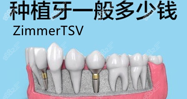 种植牙一般多少钱的图片