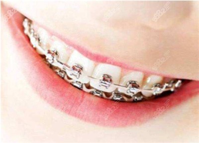 2022湖南<!--<i data=20240705-sp></i>-->口腔正畸參考價(jià)格.jpg