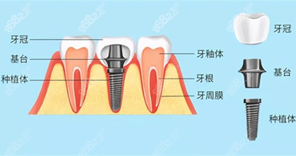 种植体的组成部分