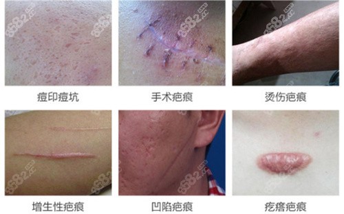 上海清沁医疗美容门诊部修复疤痕类型