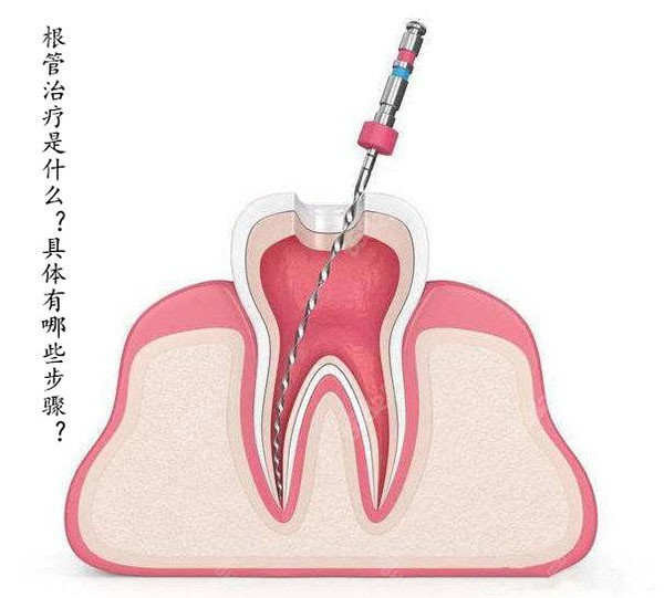 根管治疗示意图