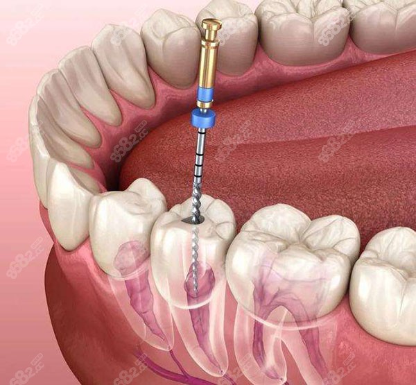 根管治疗抽牙神经