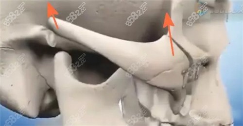 颧骨颧弓手术示意图