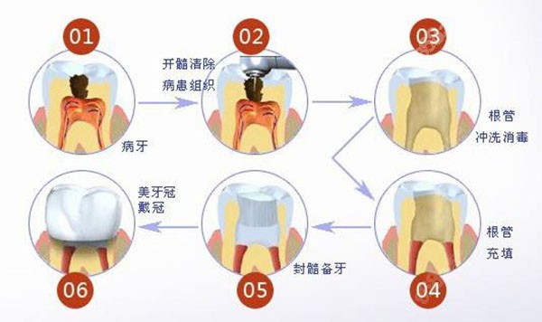 根管治疗的步骤