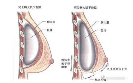 假体隆胸植入层次