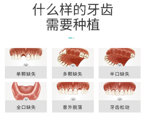 全口缺失、半口缺失等问题可以选择种植牙