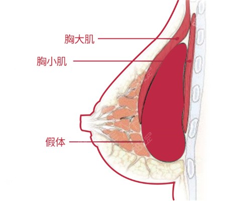 深圳曹孟君5维双平面技术隆胸