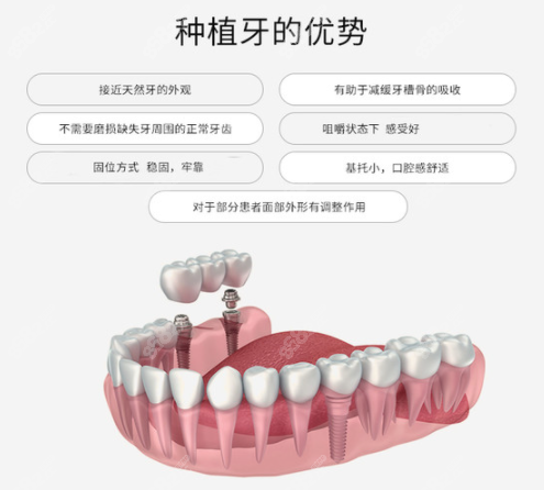 种植牙的优势