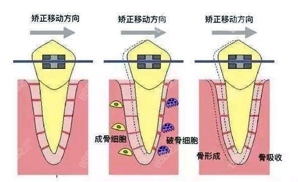 牙齿移动的牙根吸收的图片