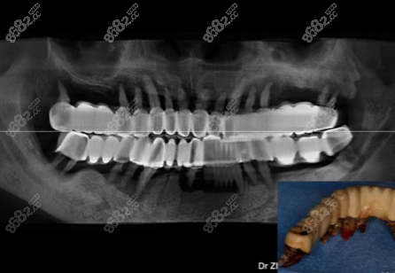 全口牙齒缺失戴的烤瓷牙冠 全口牙齒缺失戴的烤瓷牙冠
