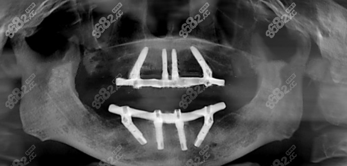 全口種植牙后的牙片 全口種植牙后的牙片