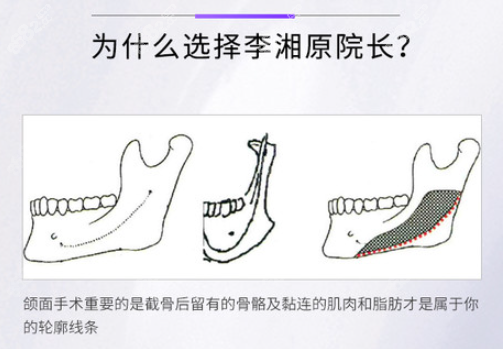 李湘原下颌角截骨优势