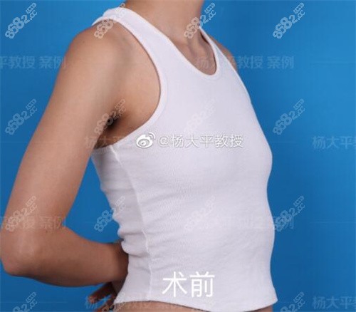 北京联合丽格医疗美容杨大平隆胸前