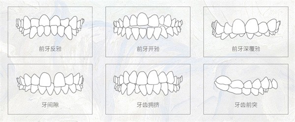 达芬奇隐形矫正标准版
