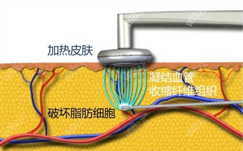 医疗美容门诊部吸脂技术