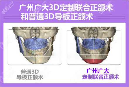 广州广大医院3d定制导板正颌技术