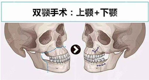 广州紫馨正颌手术价格