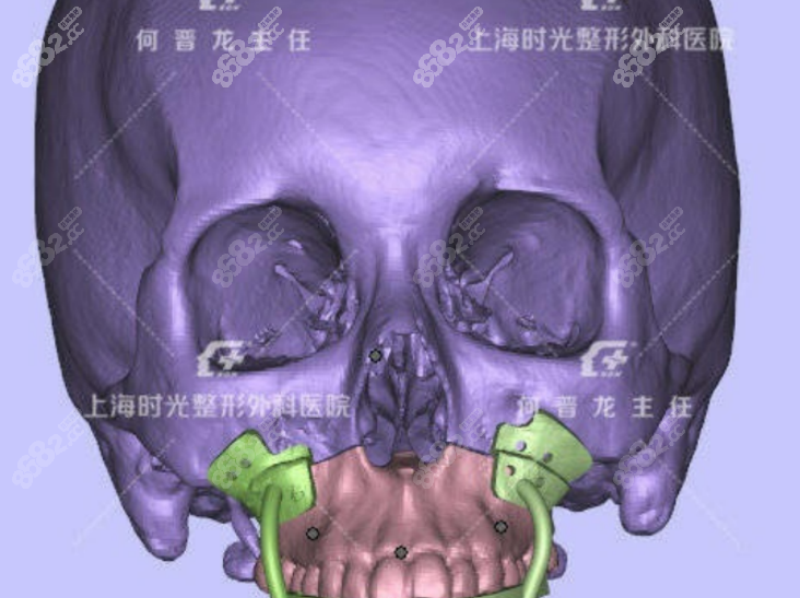 地包天患者矫正实例