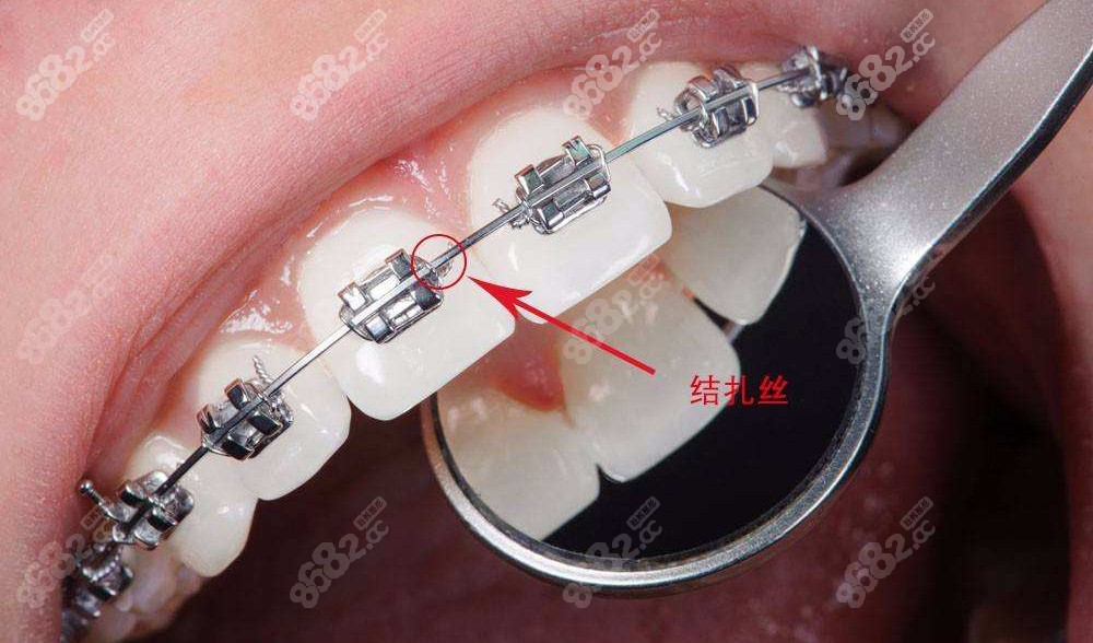 安装牙套过程图解图片