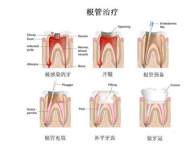 根管治疗牙齿的步骤图解奉上,看完就知根管后戴牙冠的好处