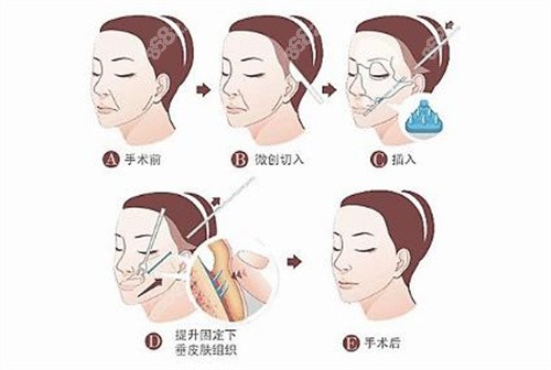 北京加减美医疗美容拉皮卡通图