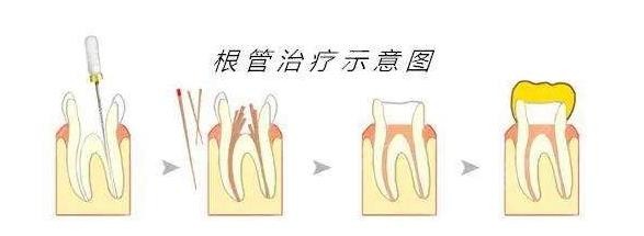 根管步骤