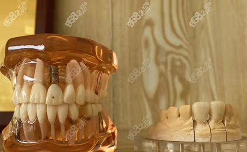 北京德固口腔做種植牙好嗎