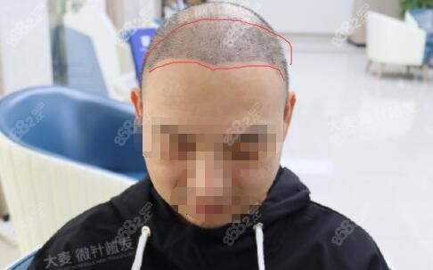 大麦微针发际线种植
