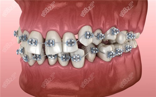 牙齿矫正图
