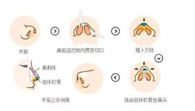 张国强院长隆鼻特点1.jpg