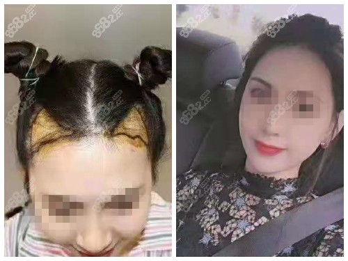 寶雞高一生整形美容醫(yī)院植發(fā)前后對(duì)比照