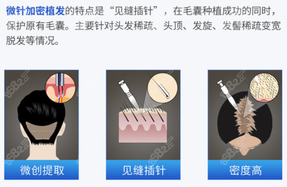 微针植发技术通过环状口径器械来提取毛囊