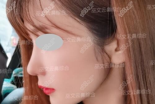 北京巫文云隆鼻术后反馈照片 北京巫文云隆鼻术后反馈照片