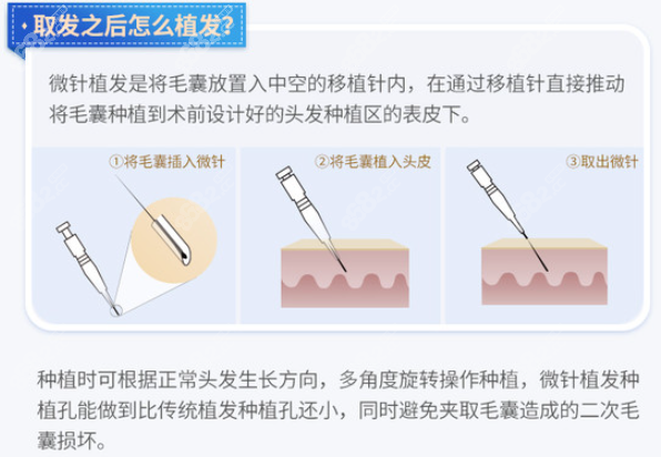 微针植发技术的原理