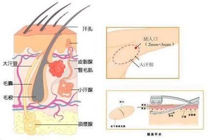 广州做微创去腋臭手术